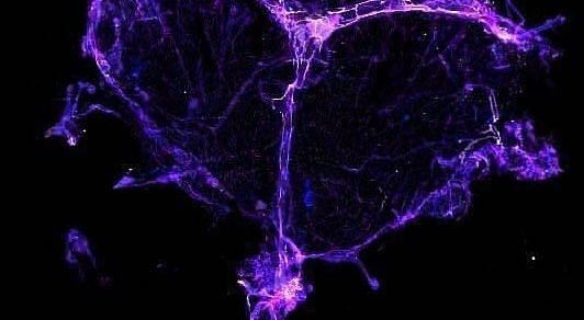 ‘Chemo brain’ may stem from damage to the brain’s drainage system