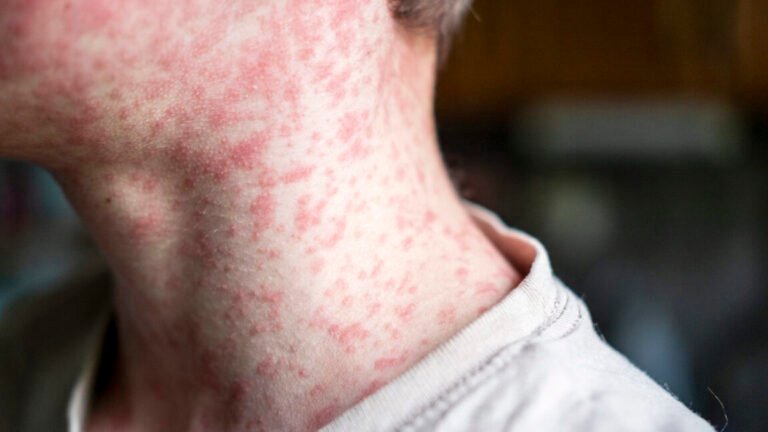 Over 250 people quarantined in South Carolina as measles outbreak rages