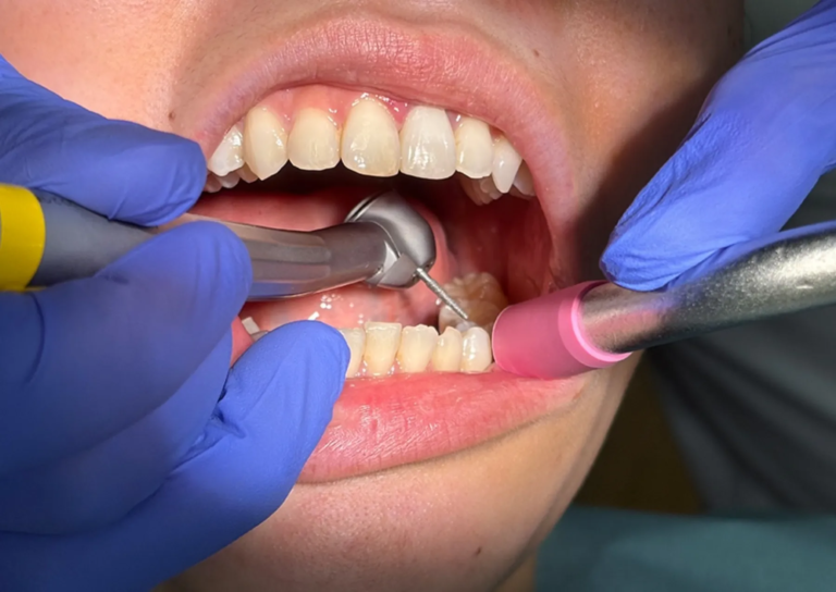 Quieter dental drills may be on the horizon